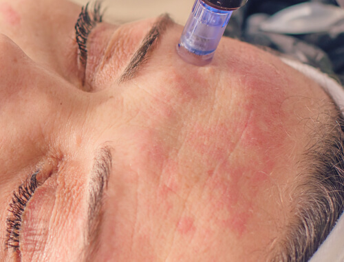 DermaPen treatment